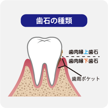 歯石の種類