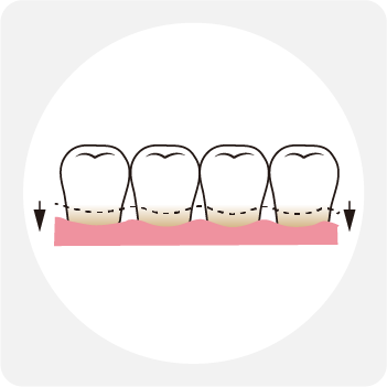 ぐきが下がる主な原因