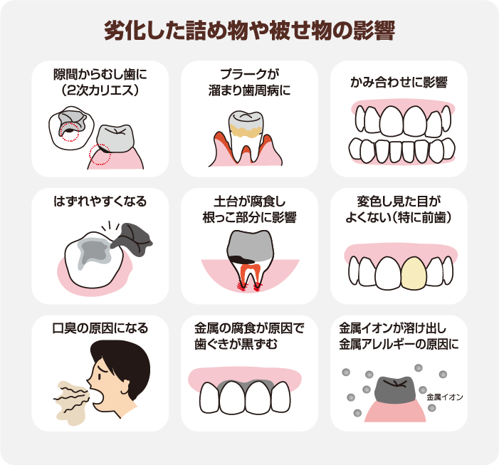 劣化した被せ物や詰め物の影響