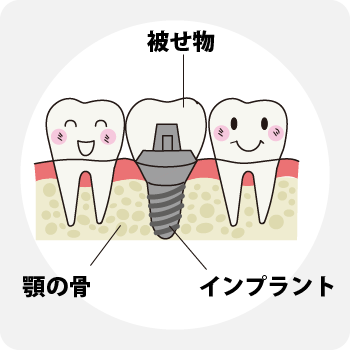 インプラント治療