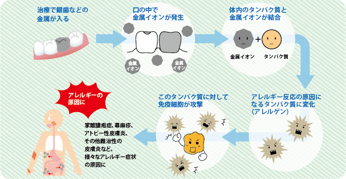 歯科金属アレルギーのメカニズム