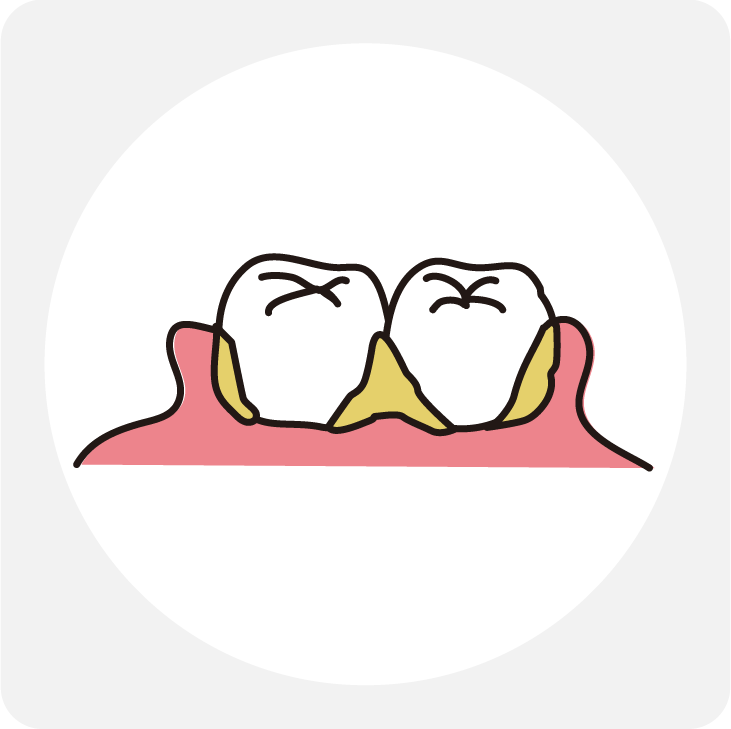 汚れや歯垢が溜まりやすくなる